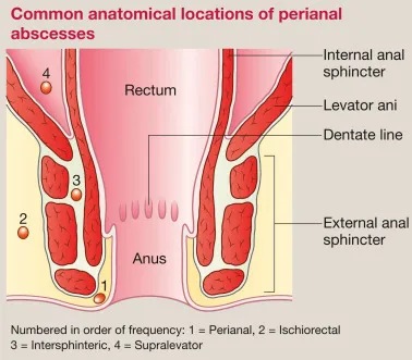 Perianal Abscess Locations