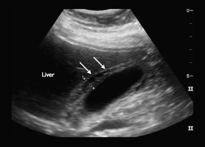 Ultrasound of thickened gallbladder wall
