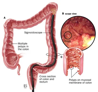 Sigmoidoscopy and colonic polyps