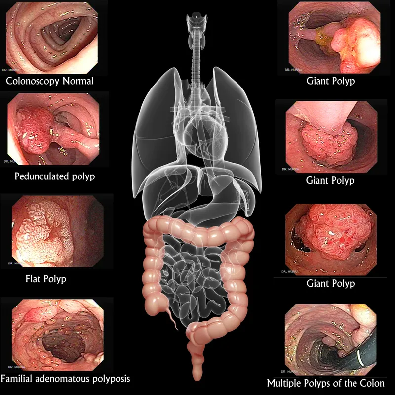 Colonoscopy views: normal, polyps, and familial polyposis