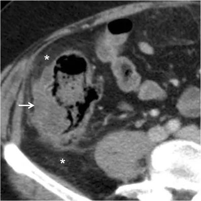 CT scan of acute diverticulitis with sigmoid wall thickening
