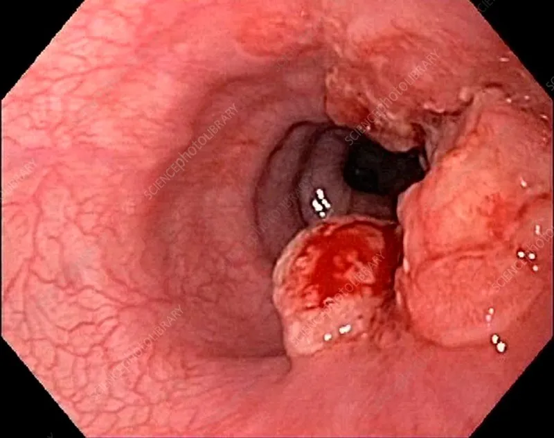 Endoscopic view of esophageal adenocarcinoma