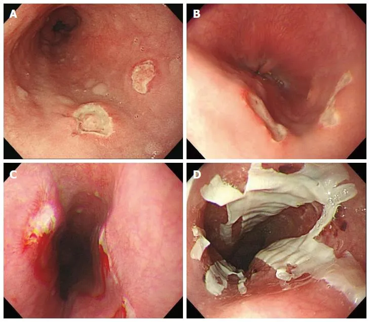 Endoscopic views of various esophagitis types