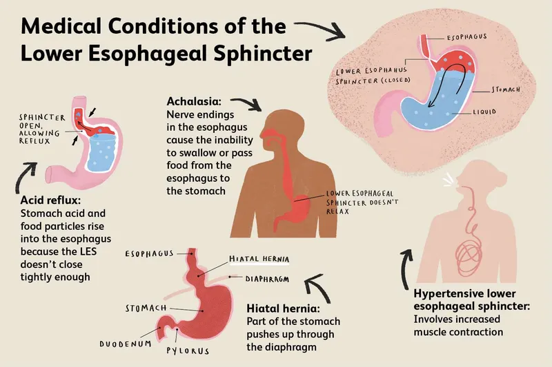 Medical Conditions of the Lower Esophageal Sphincter