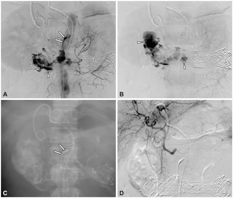 Angiographic embolization of bleeding mesenteric artery
