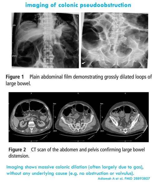 Ogilvie's syndrome: X-ray and CT findings