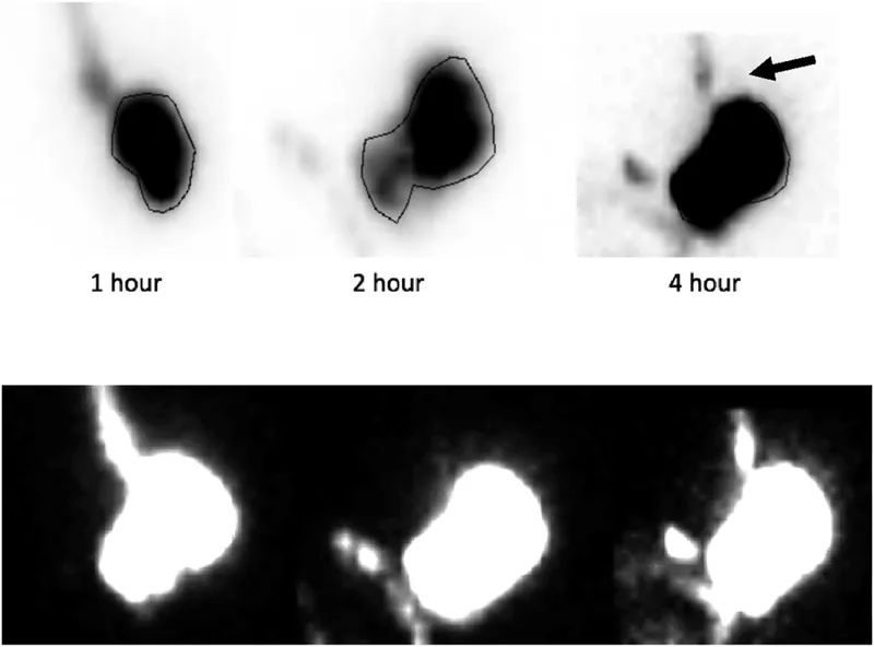 Gastric Emptying Scintigraphy in Gastroparesis
