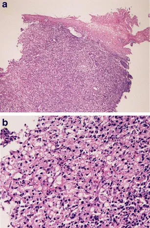Gastric signet ring cells