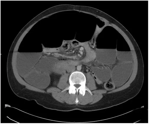 CT showing dilated bowel loops in pseudo-obstruction