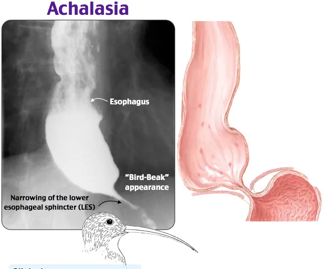 Achalasia: Barium swallow bird beak sign