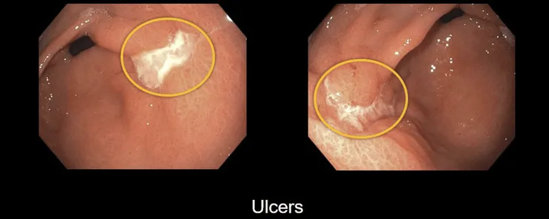 Endoscopic view of peptic ulcers