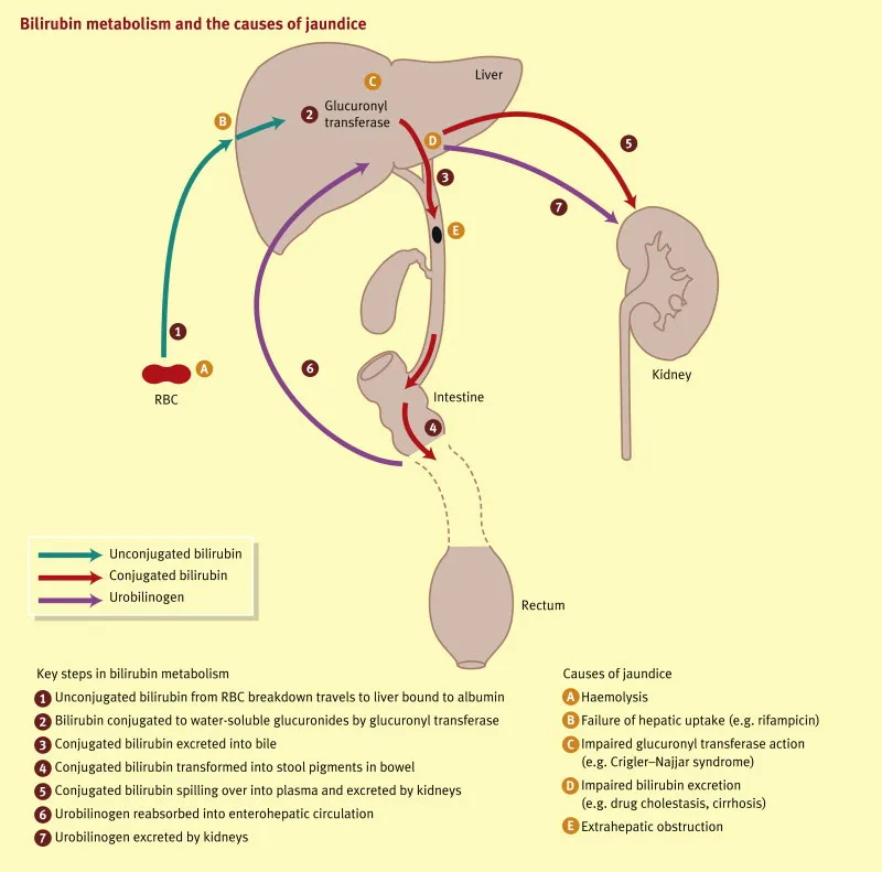 Bilirubin metabolism and jaundice causes
