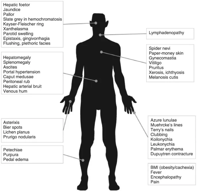 Stigmata of Chronic Liver Disease