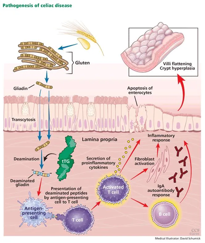 Pathogenesis of Celiac Disease