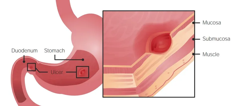 Peptic ulcer in stomach and duodenum with tissue layers