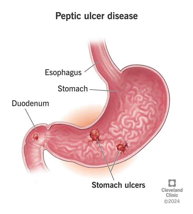 Peptic Ulcer Disease: Stomach and Duodenum Ulcers