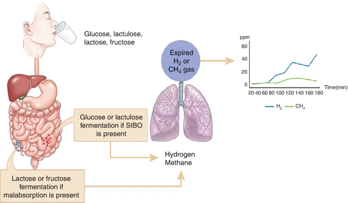 Hydrogen breath test for SIBO and malabsorption diagnosis