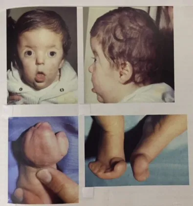 Clinical features of Patau syndrome