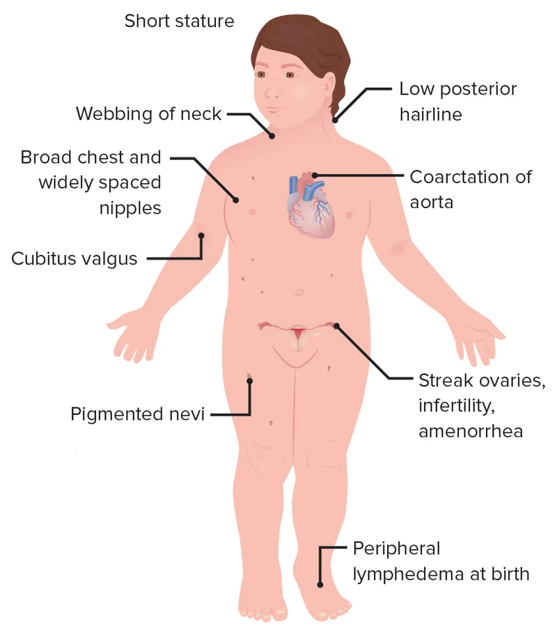 Phenotypic features of Turner syndrome
