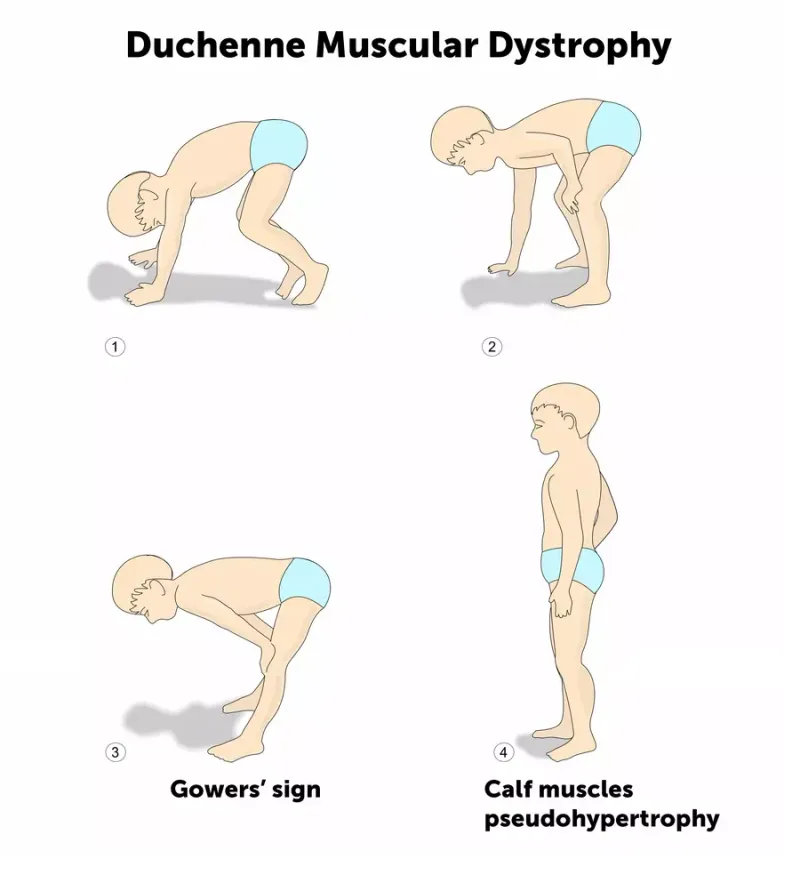 Gower's sign and calf pseudohypertrophy in Duchenne MD
