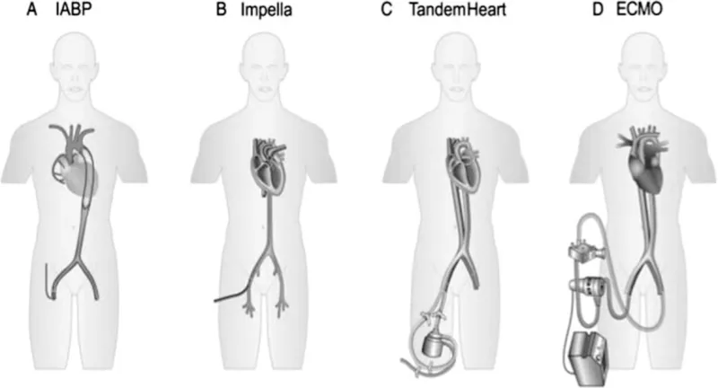 Mechanical Circulatory Support Devices Placement