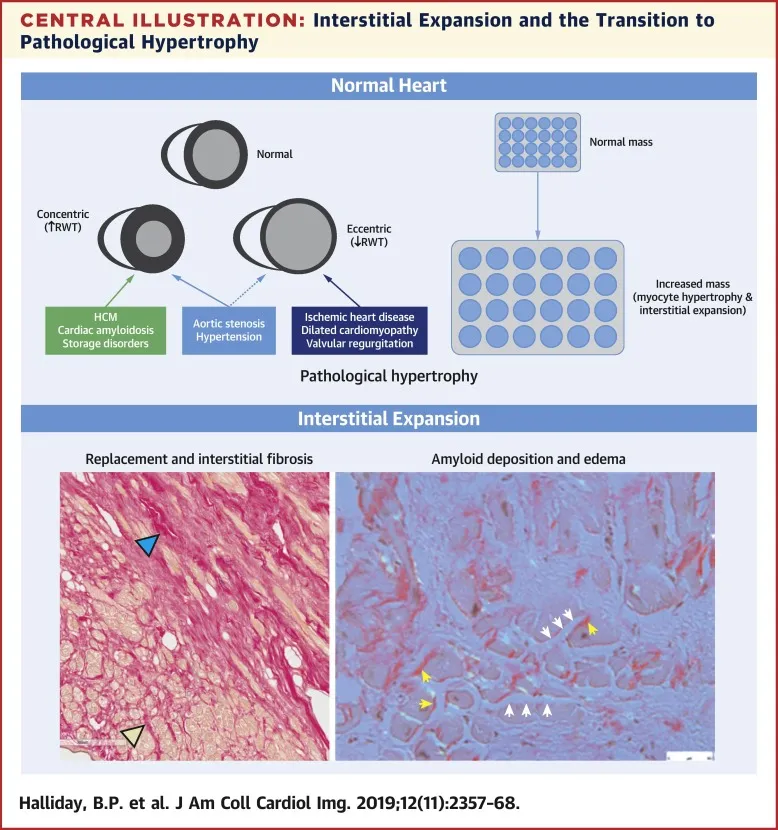 Interstitial Expansion and Pathological Hypertrophy in Heart
