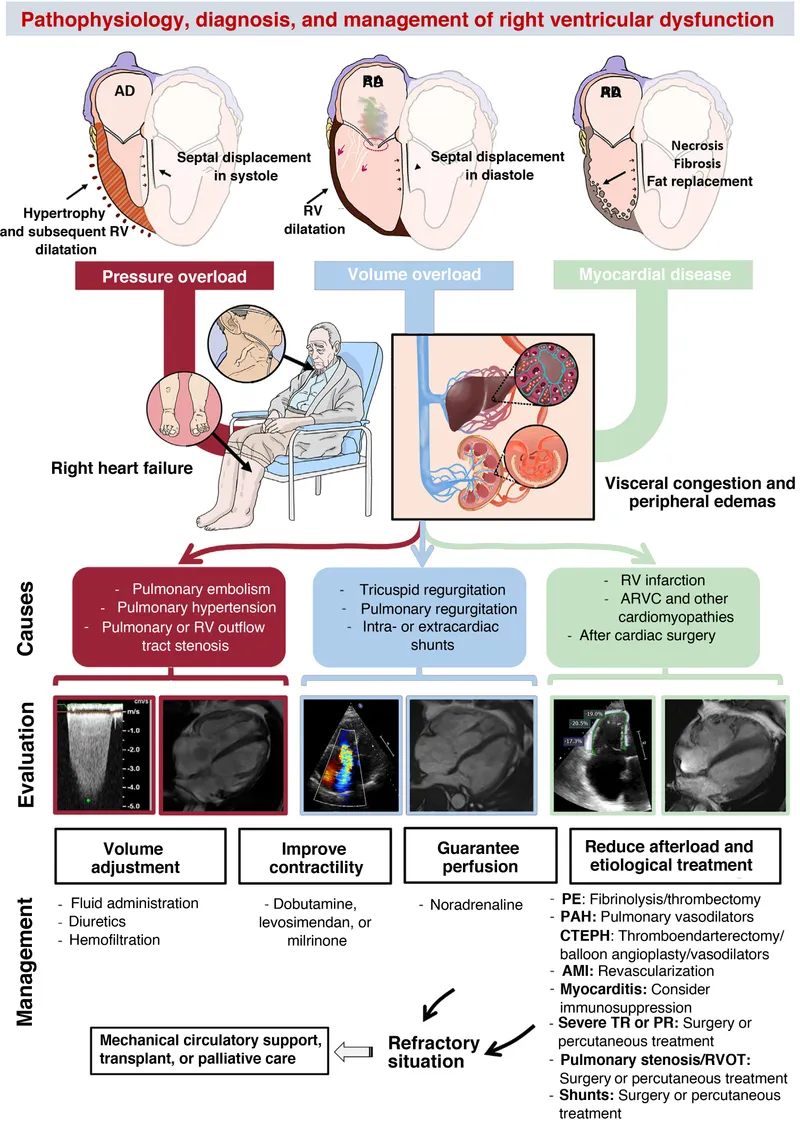 Pathophysiology, Diagnosis, and Management of RV Dysfunction
