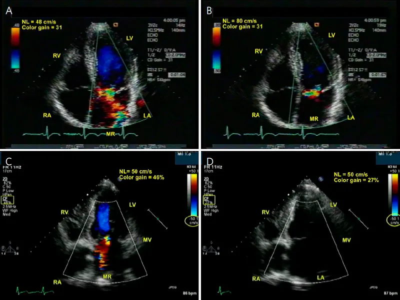 Echocardiogram: Mitral Regurgitation with Color Doppler