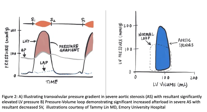Aortic Stenosis: Pressure Gradient & Pressure-Volume Loop