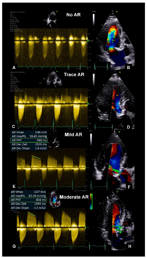 Echocardiogram: Aortic Regurgitation Severity