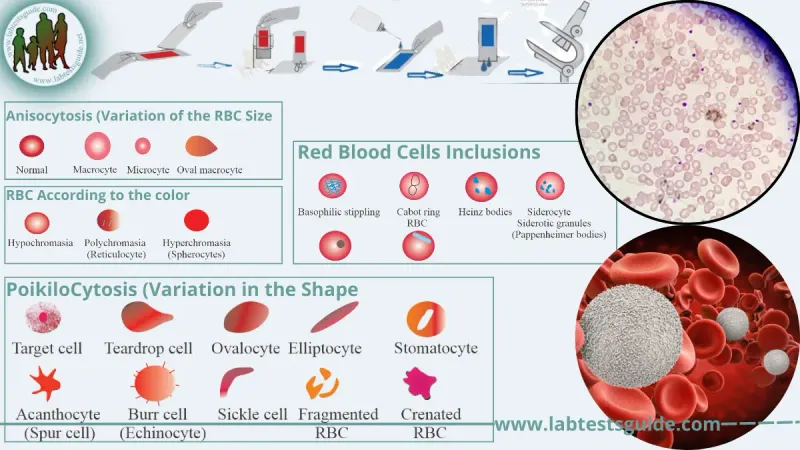 Peripheral blood smear: RBC size and color variations