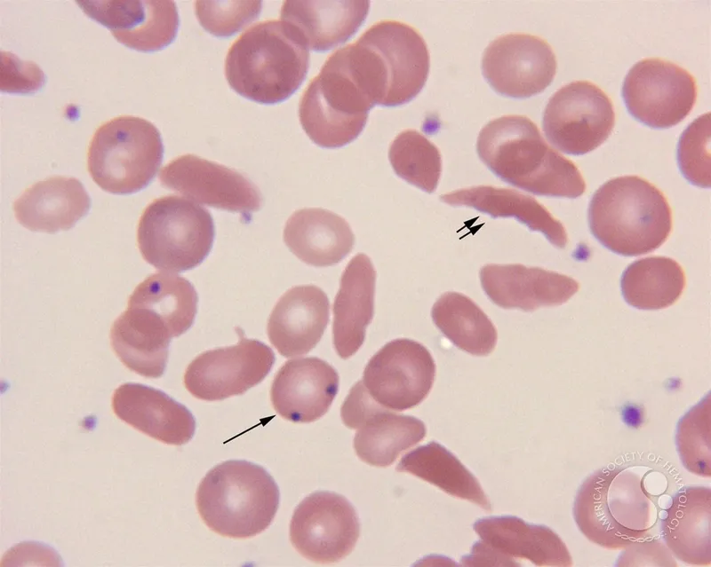 Sickle cells and Howell-Jolly bodies