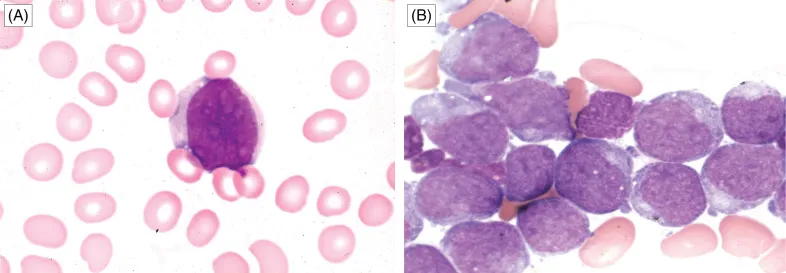 ALL vs AML Leukemic Cells