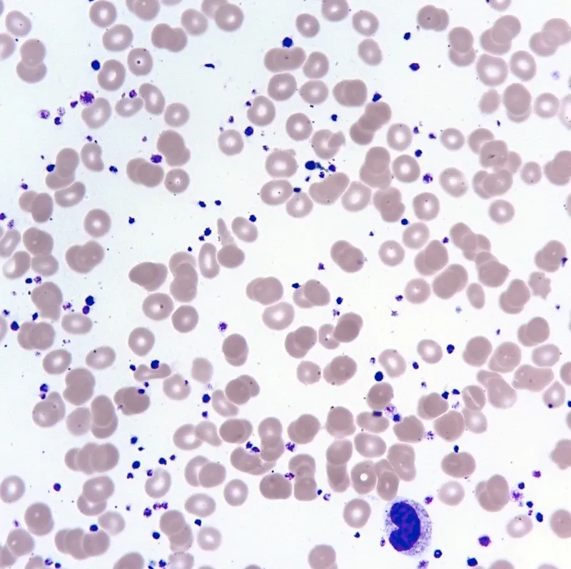 Peripheral smear: thrombocytosis, large platelets in ET