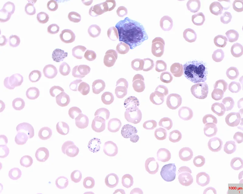 Peripheral blood smear in Thalassemia