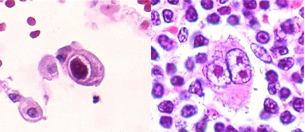 Reed-Sternberg Cells: Owl Eye Appearance