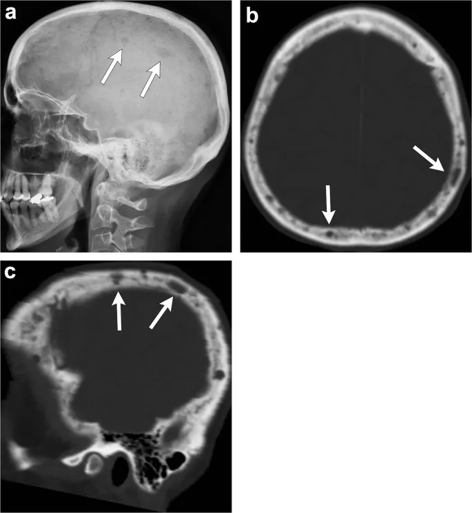 Multiple Myeloma: Skull X-ray and CT with lytic lesions