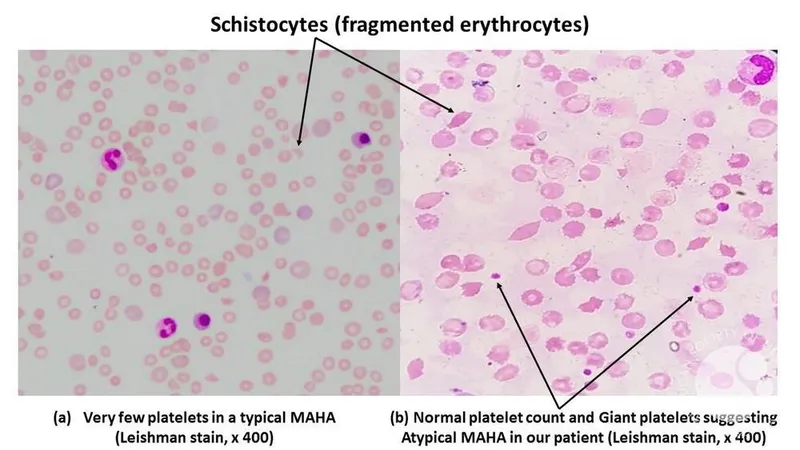 Schistocytes in Microangiopathic Hemolytic Anemia (MAHA)