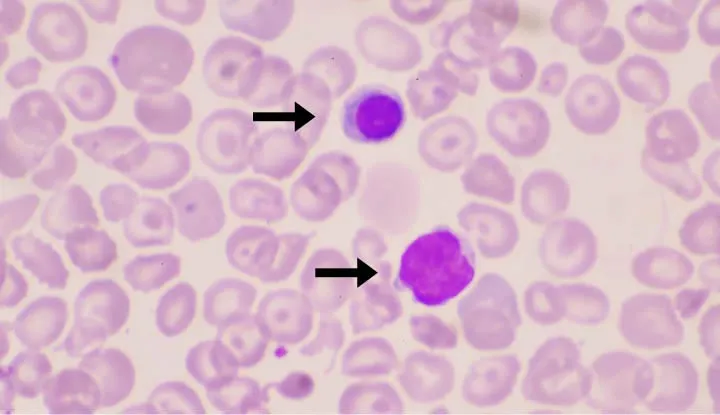 Blood smear: schistocytes, polychromasia, and nucleated RBCs