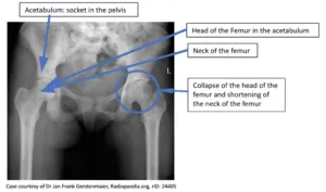 X-ray: Avascular necrosis of femoral head in sickle cell