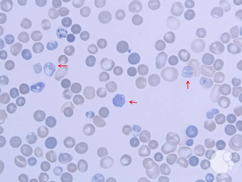 Peripheral smear of HbH disease with golf ball cells