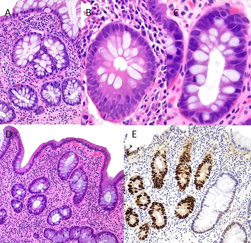 Histology of colitis-associated dysplasia in IBD