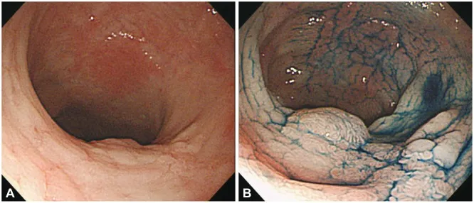 Chromoendoscopy for dysplasia in ulcerative colitis