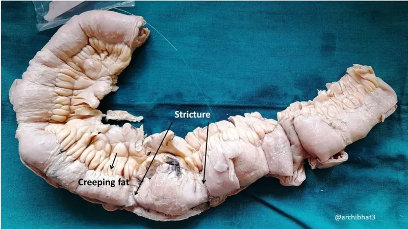 Crohn's disease gross pathology: stricture & creeping fat