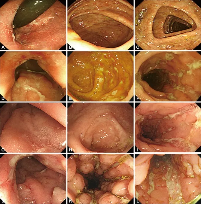 Endoscopy of Crohn's disease: cobblestone mucosa, ulcers