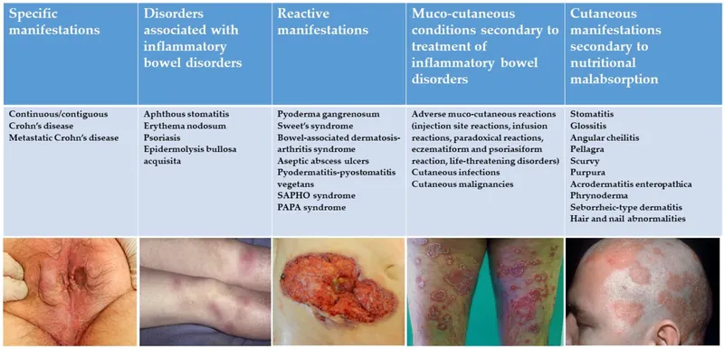 Cutaneous Manifestations of Inflammatory Bowel Disease