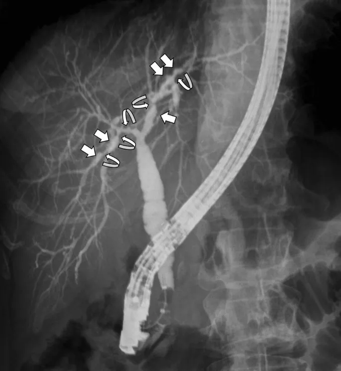 Cholangiogram: Beaded Bile Ducts in PSC