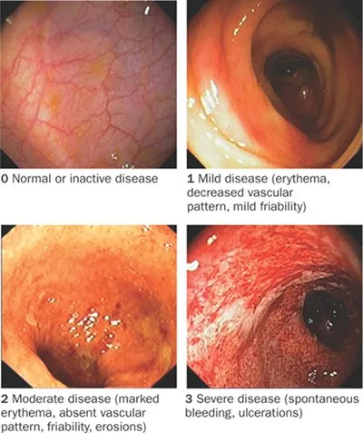 Endoscopic Ulcerative Colitis Severity Scale