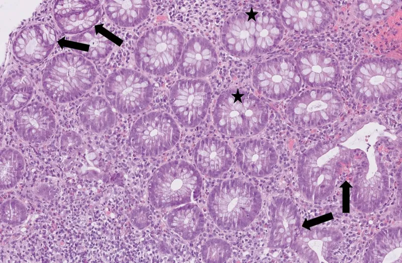 Ulcerative Colitis: Crypt Abscesses and Distorted Crypts