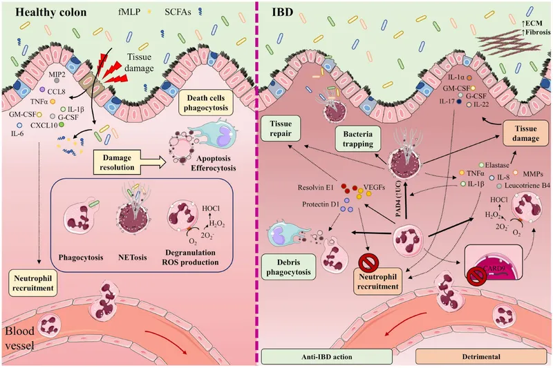 Ulcerative Colitis Pathophysiology: Healthy vs. IBD Colon